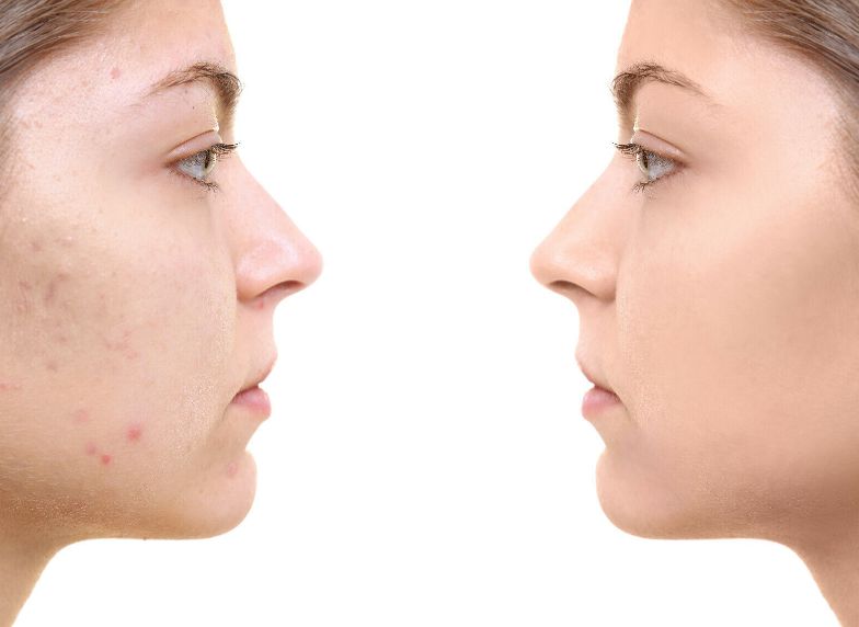 Before &After